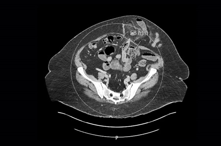 CT scan shows ventral hernia containing multiple loops of bowel.